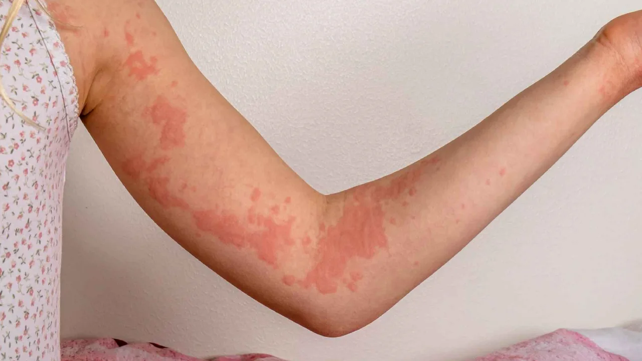Urticaria Cronica Espontanea em Minas Gerais