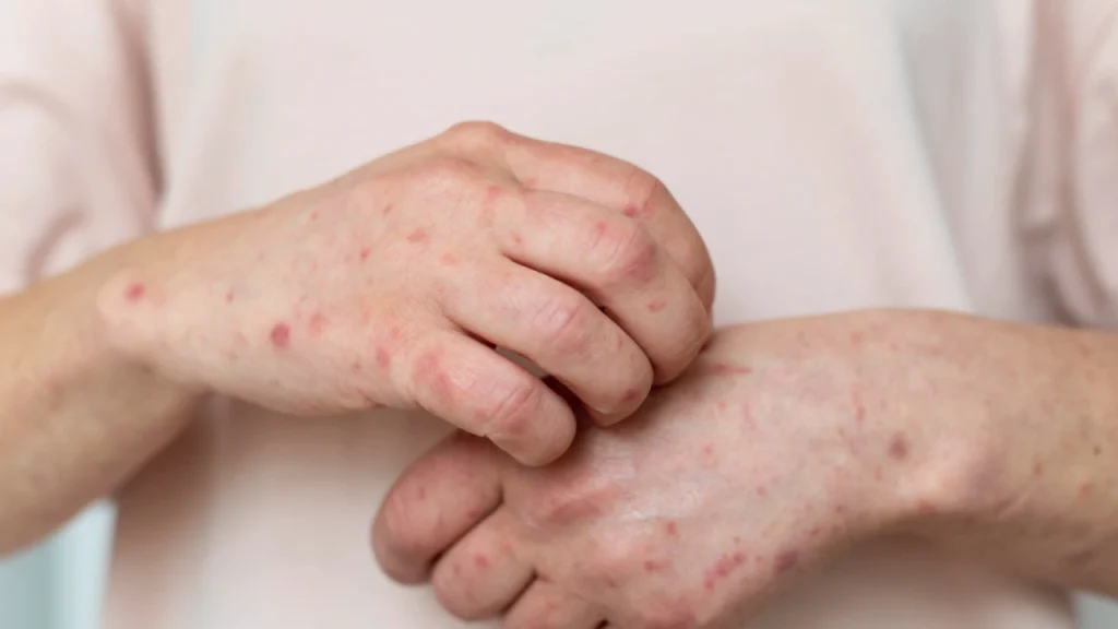 mpox aumento casos brasil