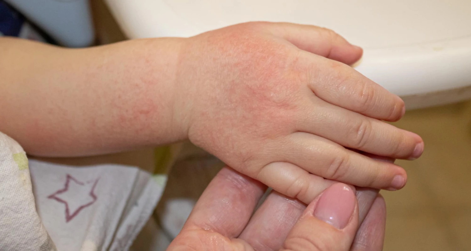 dermatite atopica infantil